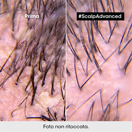 L'Oreal Serie Expert Scalp Advanced Anti-Dandruff Shampoo - Antiforfora e Seboregolatore 300ml in Capelli